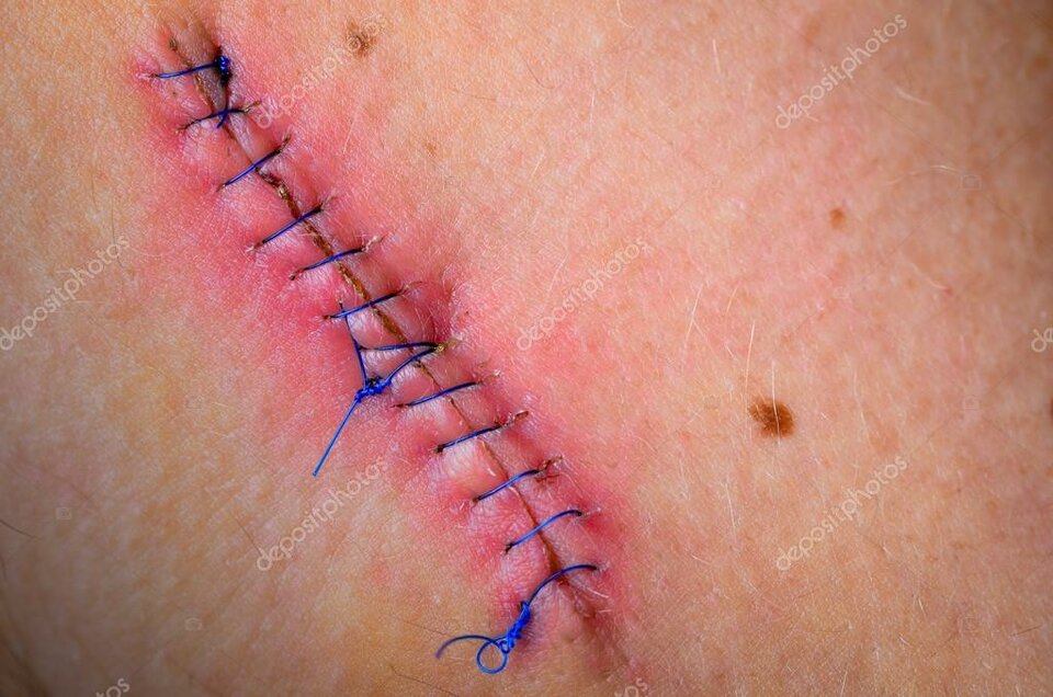 depositphotos_88566636-stock-photo-stitched-up-wound-after-mole. - Elzub